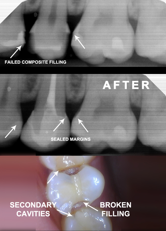 Root Canal Therapy