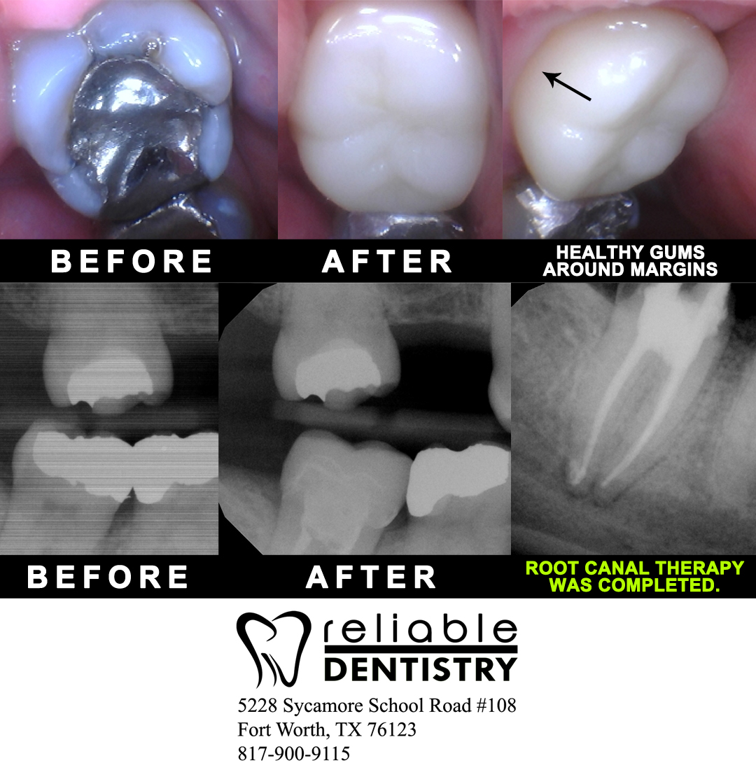 Root Canal Therapy